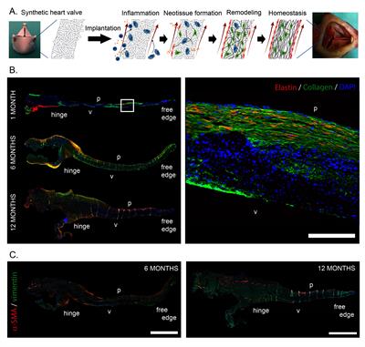 Can We Grow Valves Inside the Heart? Perspective on Material-based In Situ Heart Valve Tissue Engineering